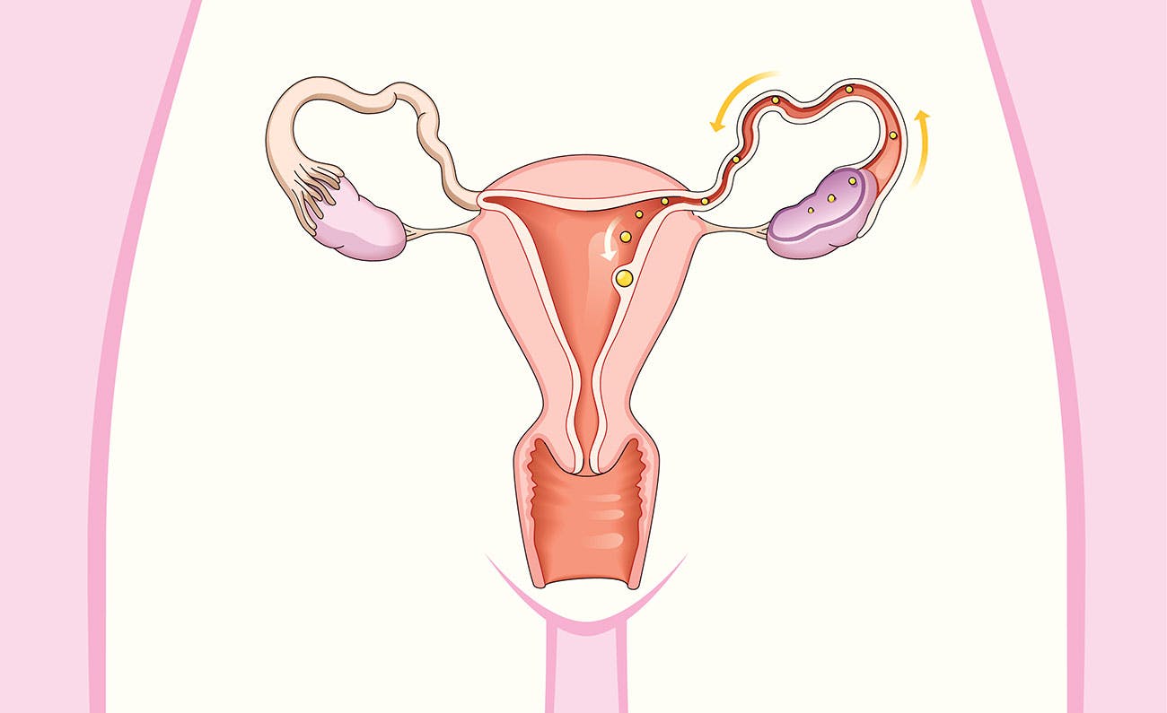 Endometriose: Behandling og symptomer.