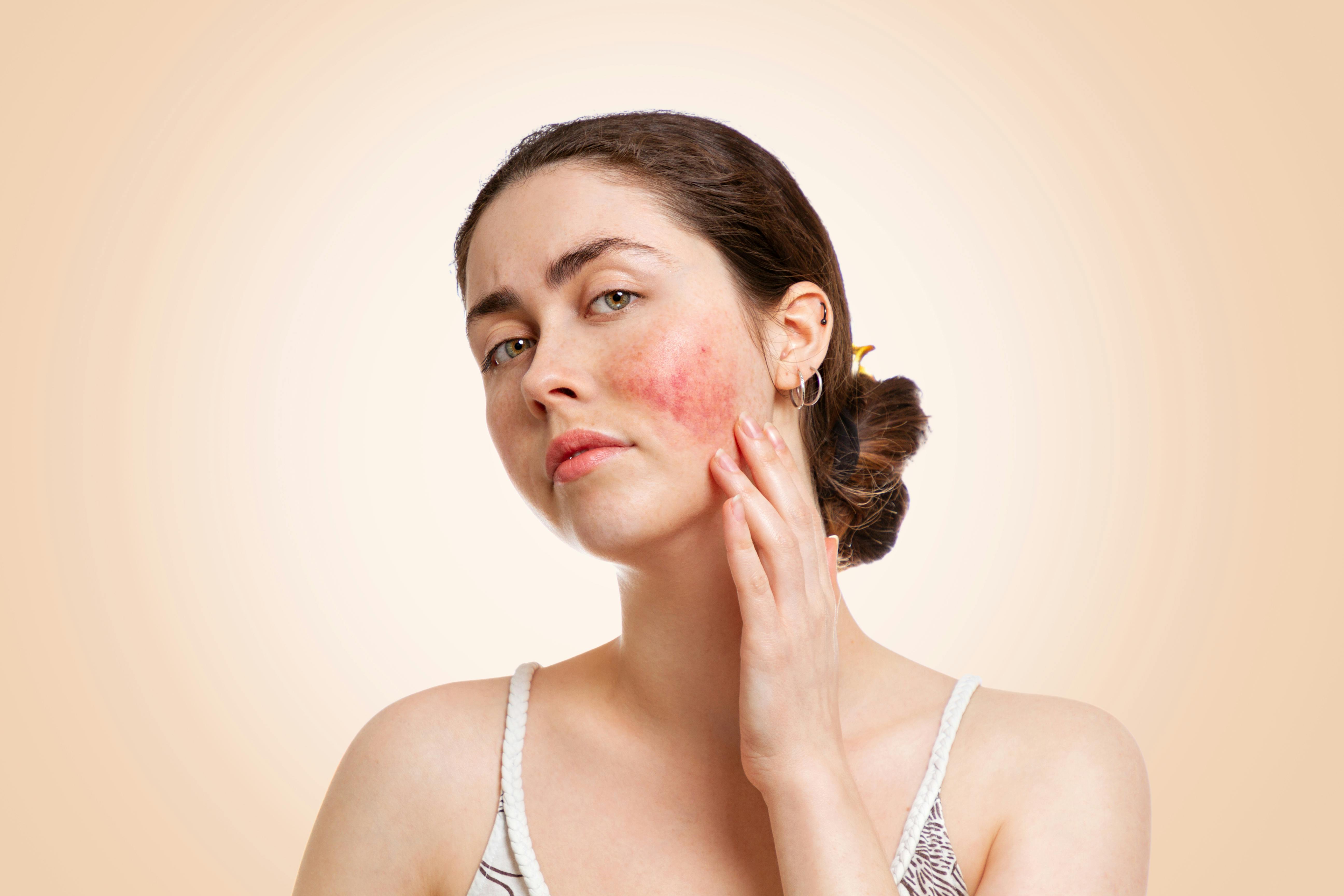 Hudsykdom rosacea