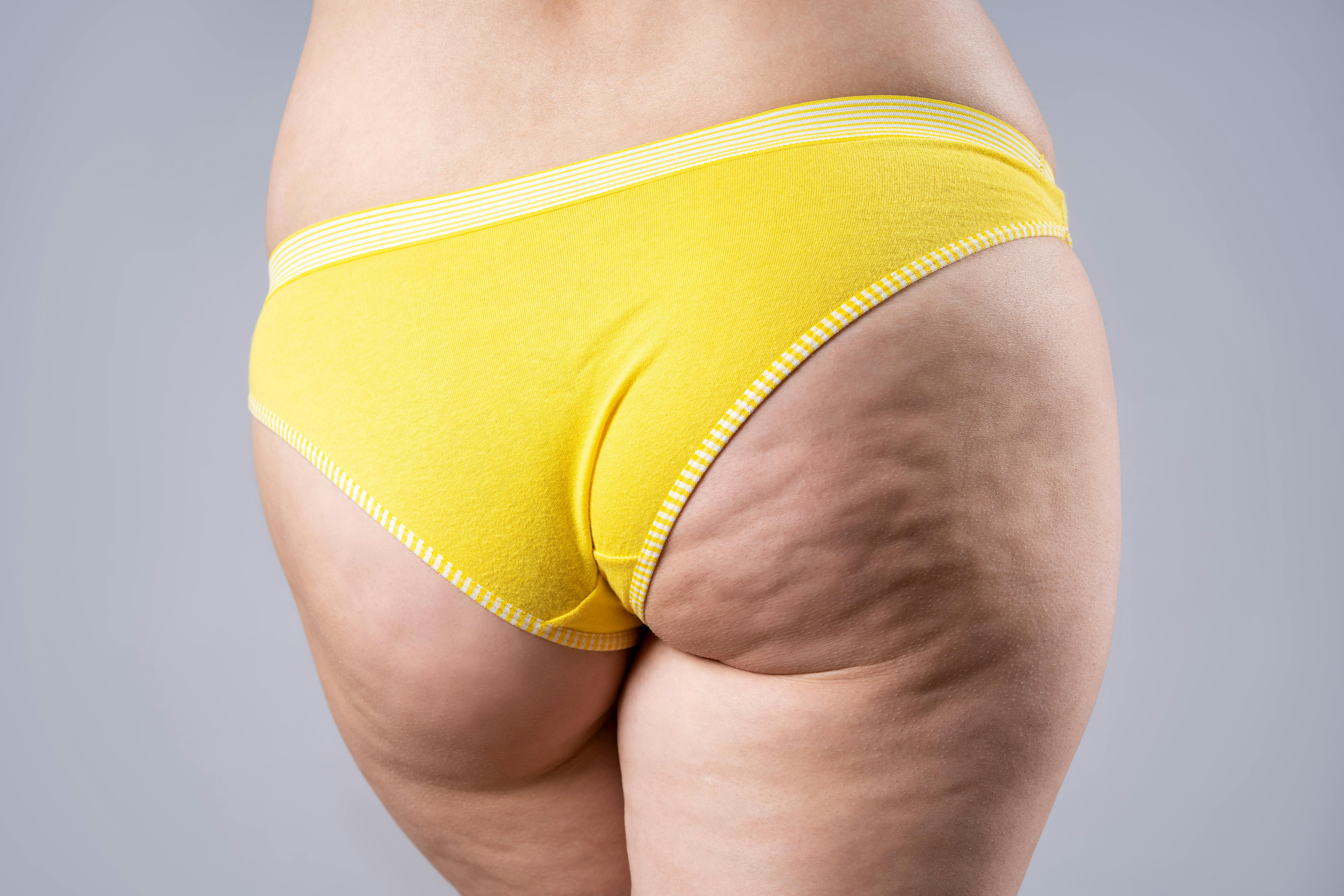 Det mest almindelige syn. 90 % af alle kvinder får altså cellulite. Cellulite, appelsinhud