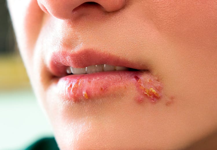 Kuvahaun tulos haulle herpes