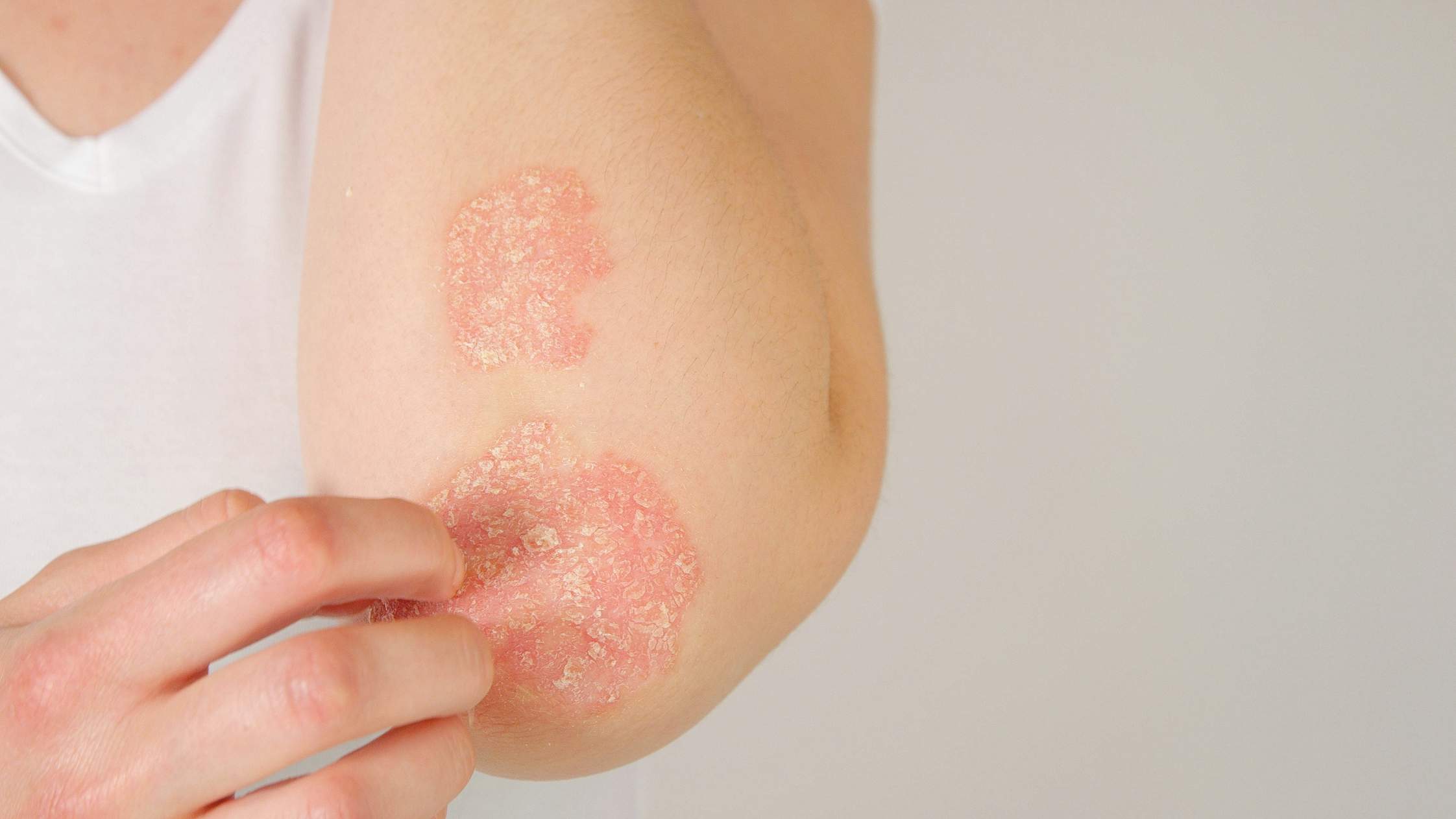 kan psoriasis smitte kan psoriasis smitte