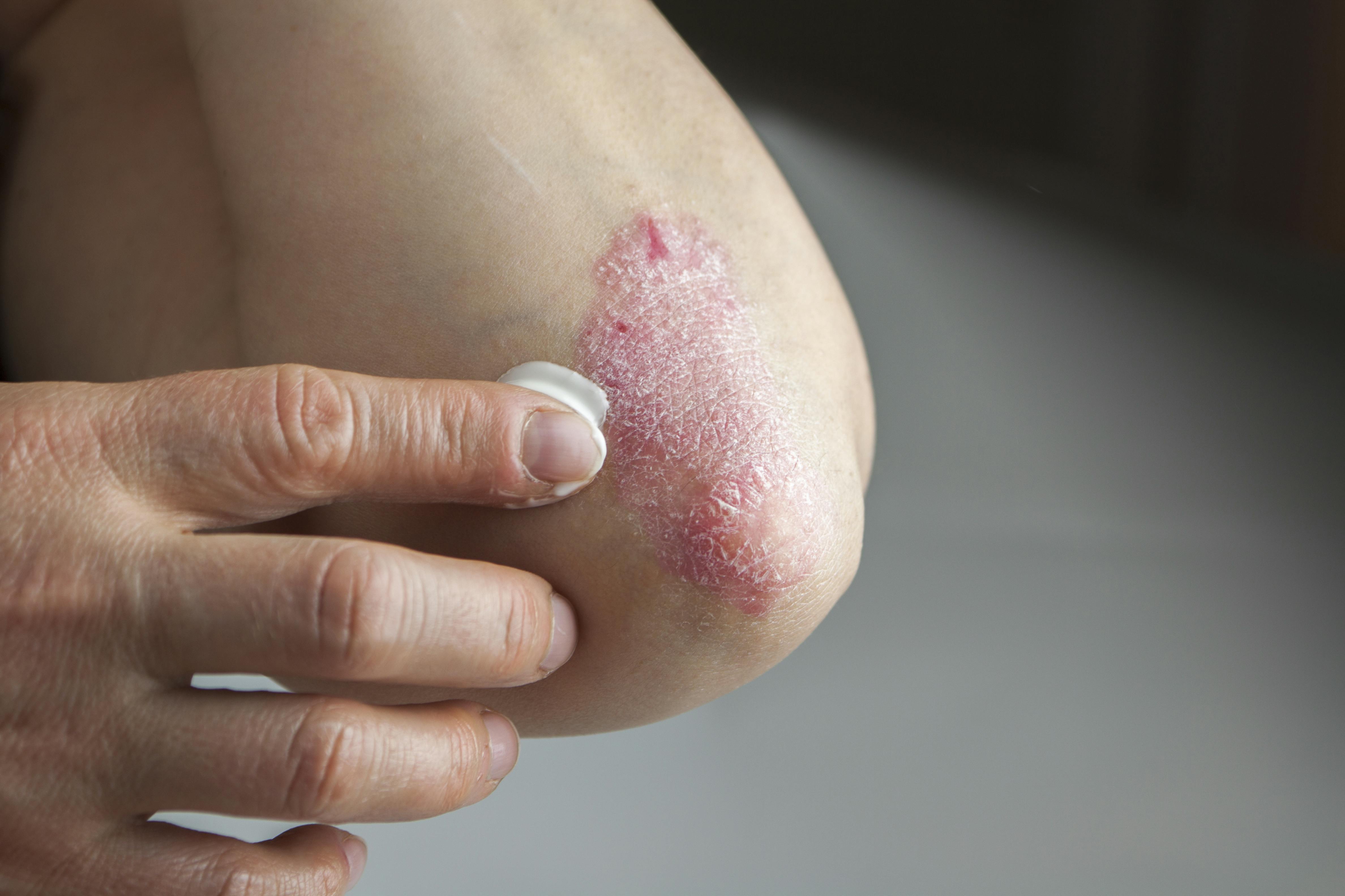 Creme mod psoriasis