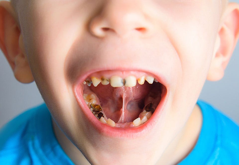 Nul gaatjes vaccin voorkomt cariës Nul gaatjes vaccin voorkomt cariës