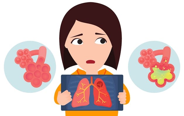 Lungebetennelse - væske og puss  i aveolene