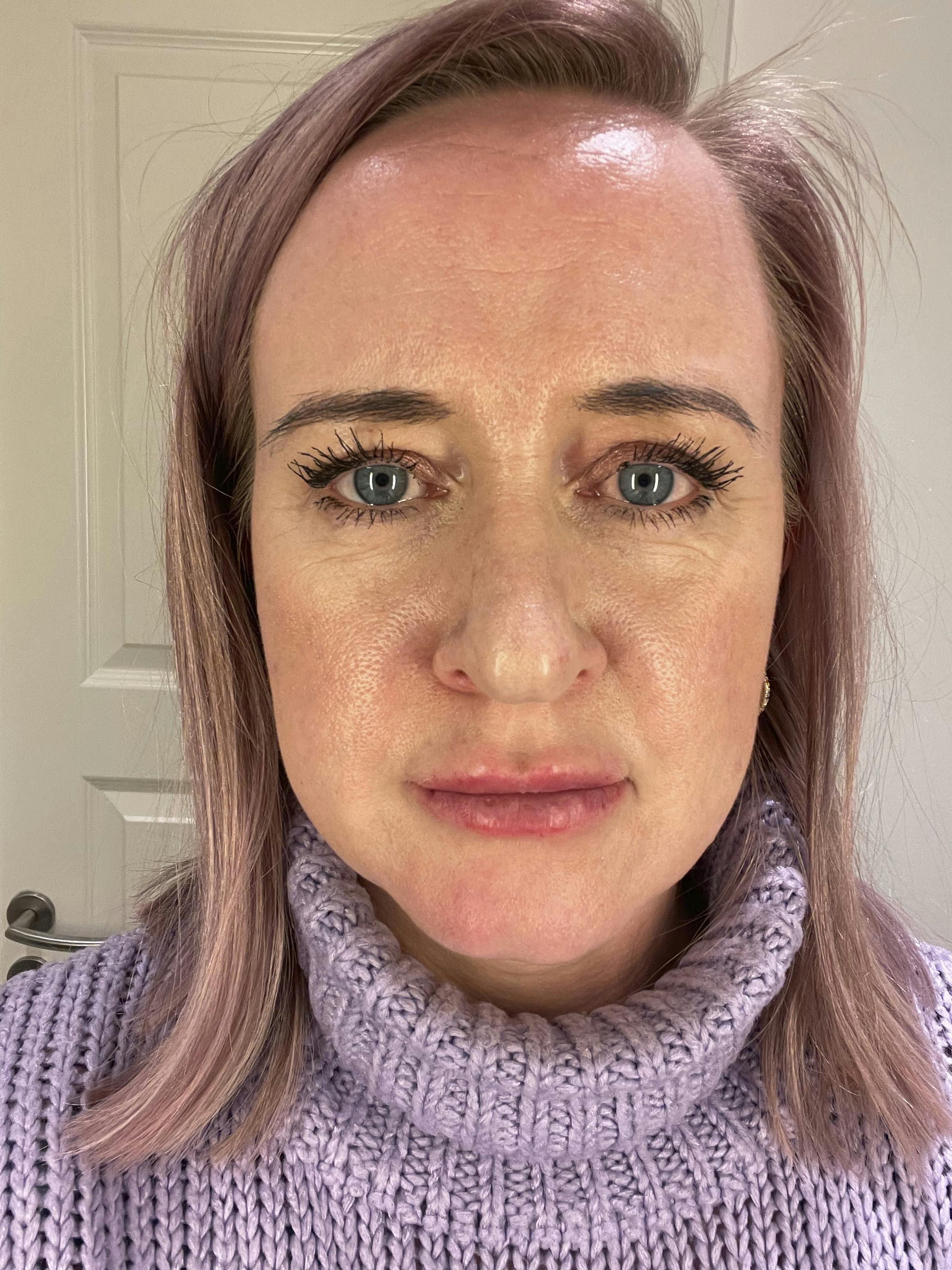 Om aftenen er læberne hævet, og Maria er lidt nervøs for resultatet. Om aftenen er læberne hævet, og Maria er lidt nervøs for resultatet.