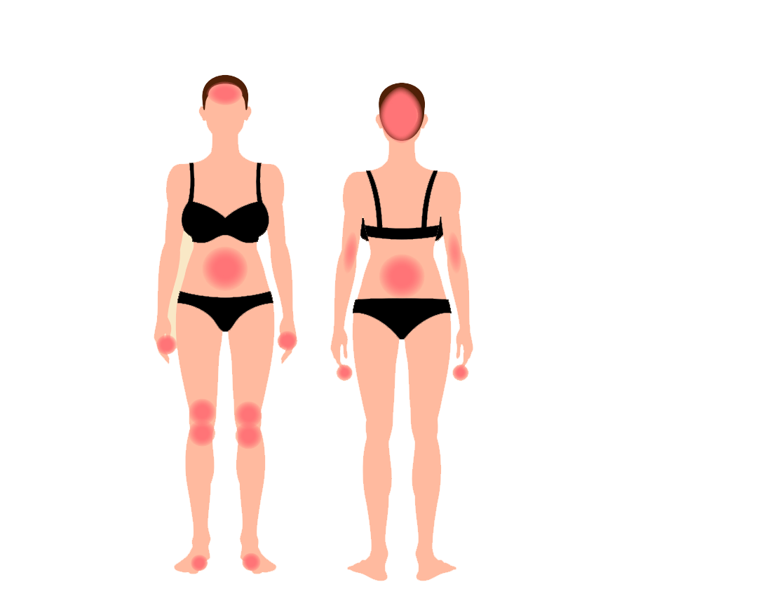 Røde pletter ved psoriasis